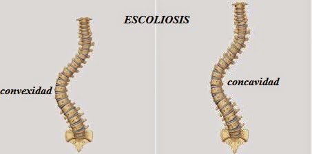 Escoliosis