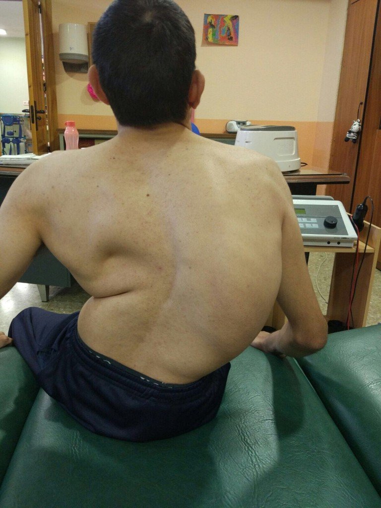 Escoliosis