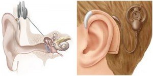 imagen implante coclear
